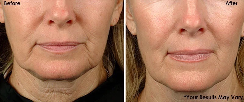 Fraxface Skin tightening before after